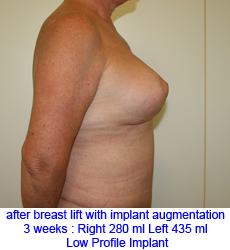 plastic-surgery-breast-lift-augmentation